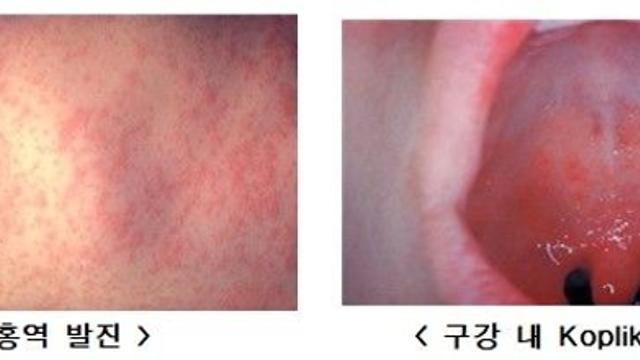 국내 홍역환자, 작년의 1.4배…