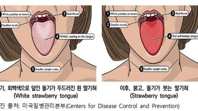 방역 당국·지자체, 성홍열 전국적 유행 조짐에 경보