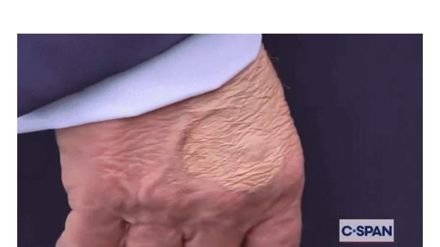 요즘 붉어지고 있다는 트럼프의 건강문제 의혹