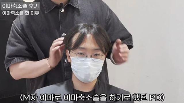 남자 모발이식 대신, 이마축소술 결과