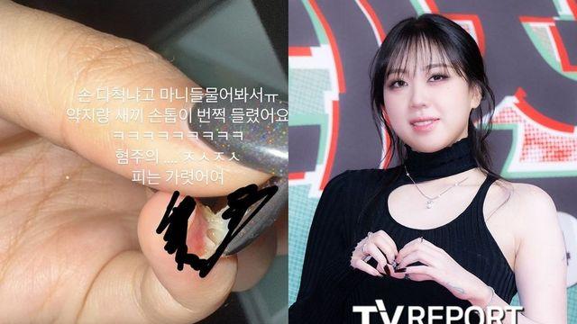 이영지, 안타까운 부상 소식…”피 철철→많이 다쳤냐고 물어봐서” [RE:스타]