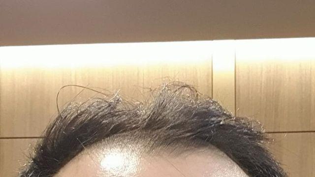 M자 + 정수리 박살났던 놈, 5000모 심고 이제야 뭔가 사람 같다