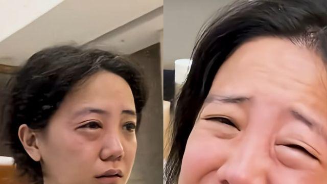 고은아, 안면부상 이어 또 비상…역대급 눈 알레르기