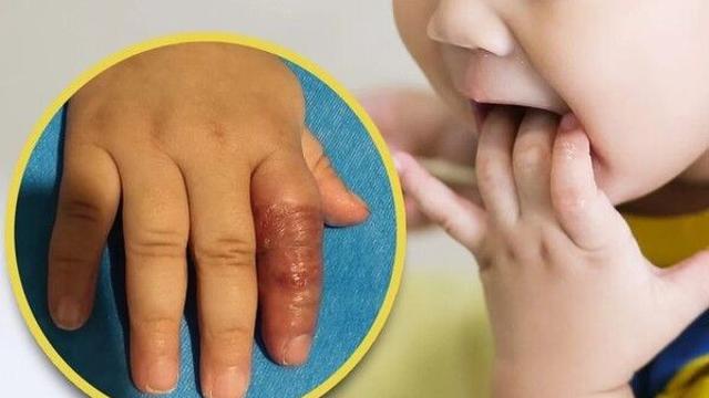 잘못된 육아 팁 따라했다가…아기 손가락 절단 할 뻔