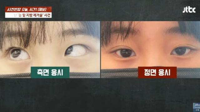 “눈 지방제거 수술 후 ‘사시’ 됐다”…성형외과서 무슨 일이