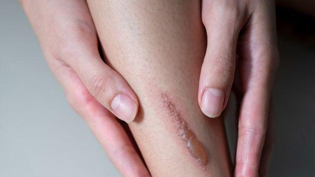 “비대성 흉터, 메타오닌 제한으로 치료 가능성 열려”