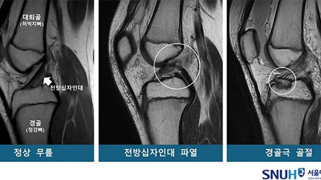 소아청소년 무릎 부상, ‘타고난 구조’에 따라 다르다