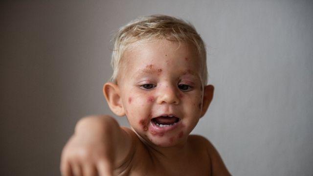 여름철 영유아 농가진 급증, 원인과 예방 방법은?