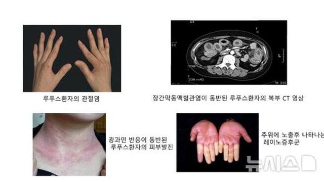 피곤하고 얼굴에 ‘나비모양’ 반점…피부병 아닌 ‘이 질환'[몸의경고]