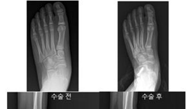 소아 평발 대표 수술법 ‘종골 연장술’ vs. ‘종골 정지술’ 치료 효과 비교 연구 결과는?