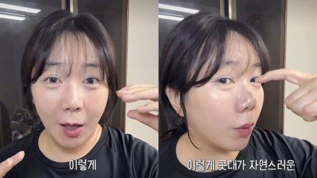 허안나, 코 성형 부작용에 재수술 