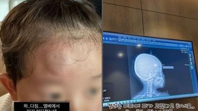 김보미, 아들 머리 부상에 병원行…