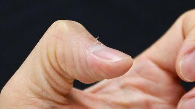 '손톱 주변' 거스러미 함부로 뜯지 마세요…이유는 '이것'