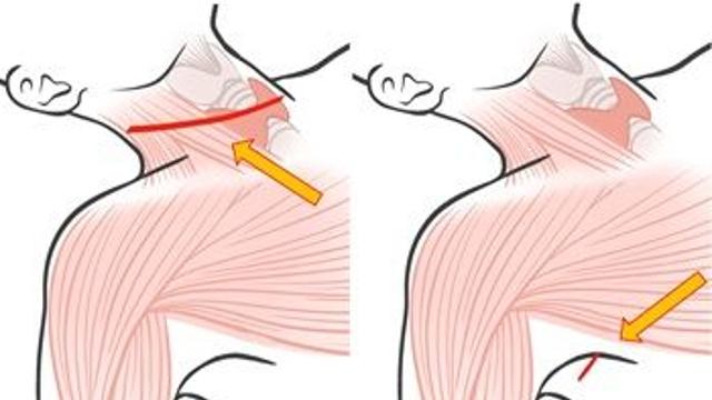 ‘갑상선암’ GOSTA 수술법 vs. 측경부임파선곽청술 비교·평가 결과는?