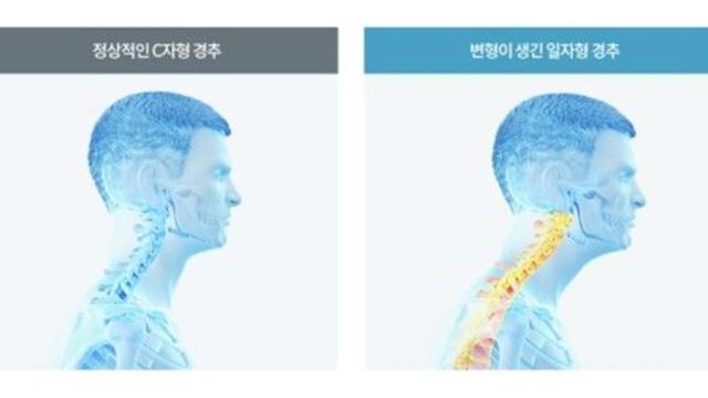 거북목 증후군, 목 건강을 위협하는 현대인의 작은 습관