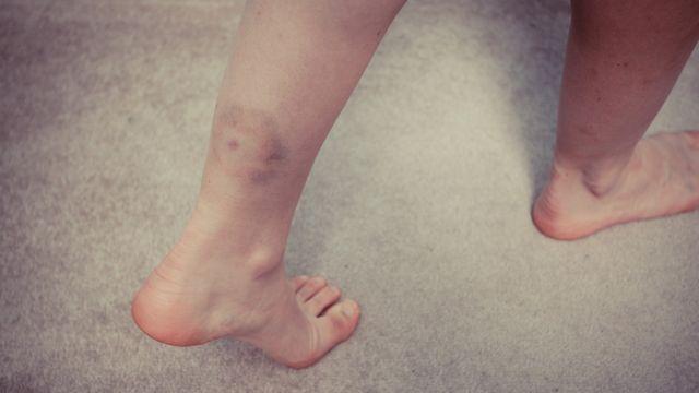 잦은 피로와 명, 단순 빈혈일까?... ‘이 질환’ 의심해야 하는 이유