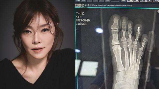 차지연, 공연 연습中 골절상…”심장 덜컹, 나사 박는 수술 받아”