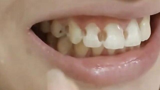 5년 교정 끝에 치아 8개 '구멍' 생긴 中여성…원인은?
