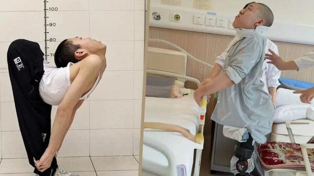中 '접힌 소년', 대수술 끝에 몸 펴…요가 매트에 누워 시험 봐