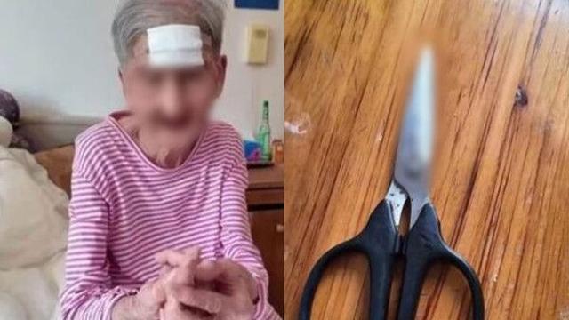 이마 '뿔 종양' 스스로 제거한 98세 中할머니…결국 응급수술