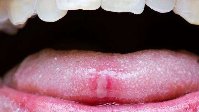 반복되는 구내염 및 눈 염증, ‘베체트병’일 수 있어