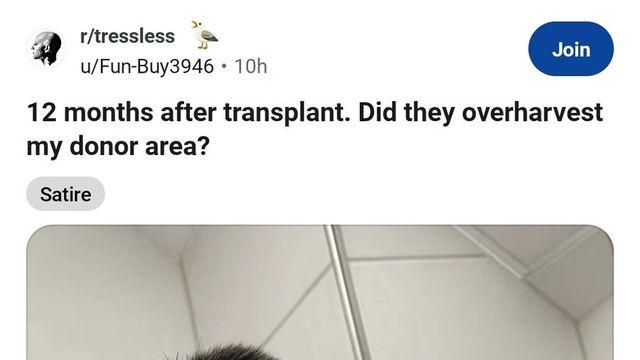 레딧에서 난리난 모발 이식 인증 글jpg