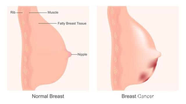삼중음성유방암, 환자 암조직 활용 맞춤형 면역치료 희망 보인다