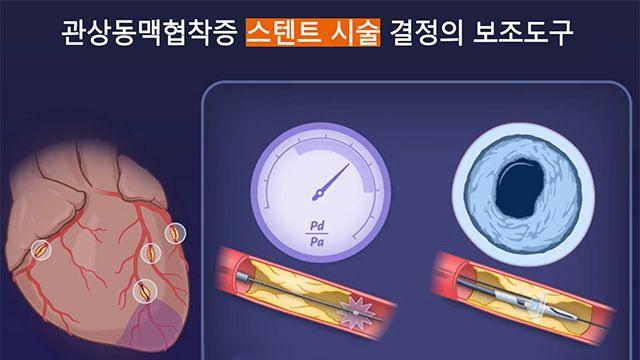 관상동맥 스텐트 시술, 장기 예후는 유사…불필요 시술·재시술 예방 효과는 달라