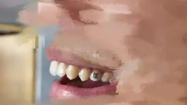문신, 이제 치아에도…중국 젊은층 사이 '치아 문신' 유행