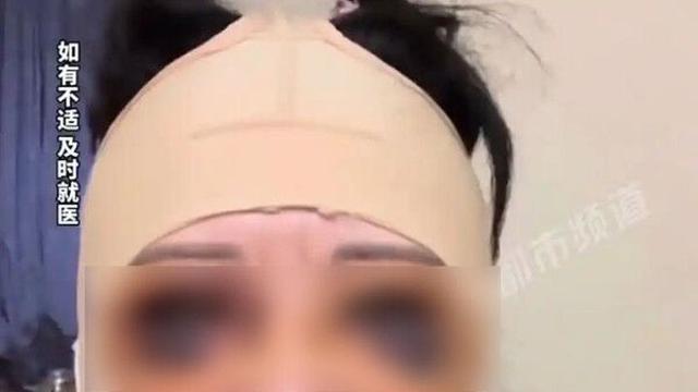 눈·입 주변 시커멓게…성형 부작용에 '판다 얼굴' 된 中 여성