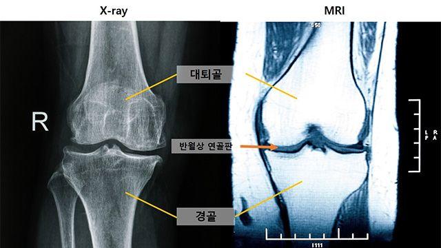 무릎 관절염, MRI서 먼저 보이는 ‘초기 신호’ 찾았다