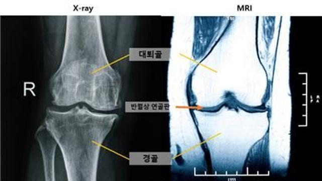 무릎 관절염 조기 발견 새 진단 지표 확인…MRI ‘내측 반월상 연골 돌출’ 관찰시 관절염 위험
