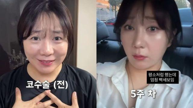 “코 때문에 욕 먹어”…허안나, 결국 성형수술 감행 [RE:스타]