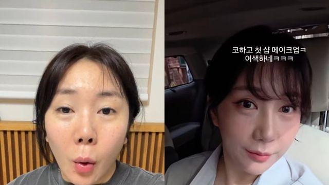 ‘구축 피해’ 허안나, 재성형 후 달라진 얼굴 “누구세요?”