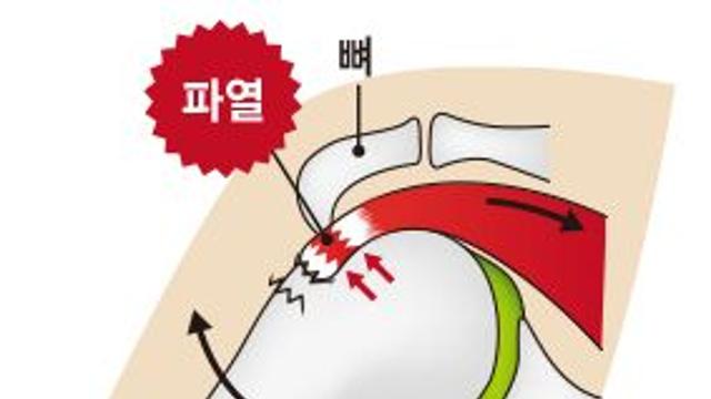 밤에 참기 힘든 '어깨 통증'…오십견 아닌 '이 질환' 의심