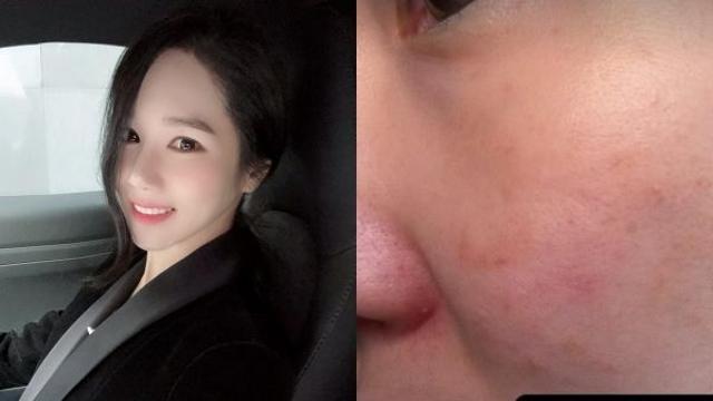 16기 옥순, 유산 후 아픔…호르몬 불균형 고백 
