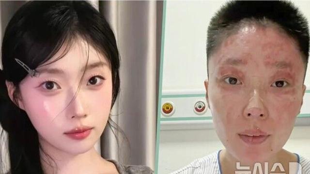가스 폭발로 얼굴 잃었지만, 17만명 팬 생겨…어떻게?