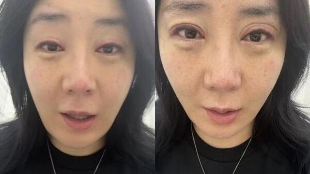 허안나, 코 재수술 이어 눈 시술 