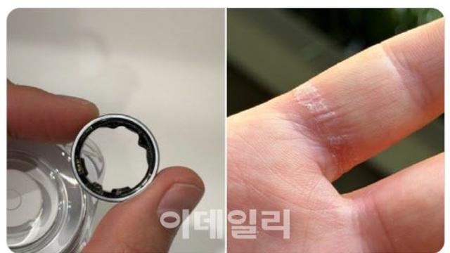 ‘갤럭시링’ 갑자기 팽창해 응급실…원인은?[모닝폰]
