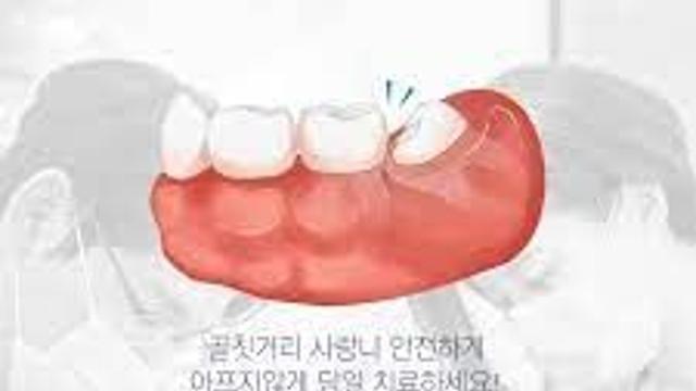 뇌로 벼락 치는 고통.