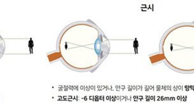 고도근시, 망막 건강의 위험 신호