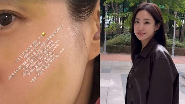 최희, 안면마비 후유증 치료하다 부작용 얻어 “볼과 눈가에 멍이..” [RE:스타]
