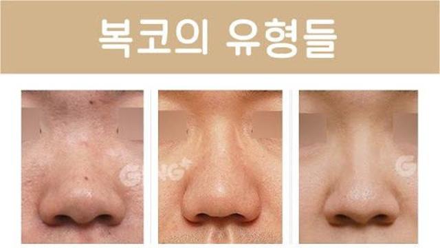 코성형해도 답이 안나온다는 유형