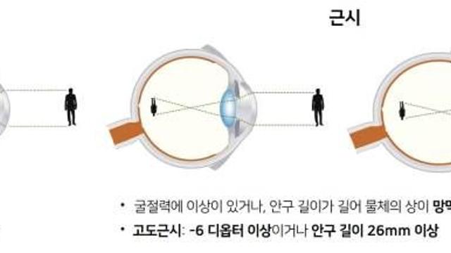늘어나는 고도근시, 망막 질환 부른다…정기검진이 최선의 예방
