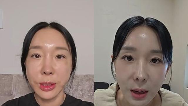 '46세' 이지혜, 시술 후 확 달라졌다…
