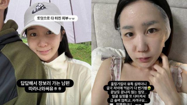 ‘암 극복→임신’ 초아 “입덧 안 끝났는데 얼굴 다 터져” [RE:스타]
