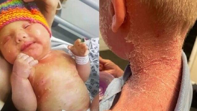 온몸에 물고기처럼…희귀질환 '어류비늘증' 갖고 태어난 아기