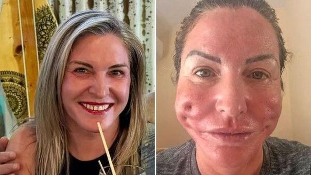 “15분 실리프팅 받고 얼굴에 구멍”…英 50대女의 악몽