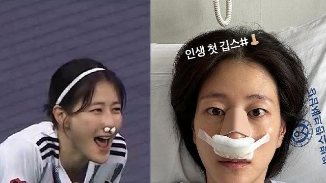'안면마비 고백' 이현이, 안구 이어 코뼈 골절…입원에 부상 순간 재조명 [엑's 이슈]