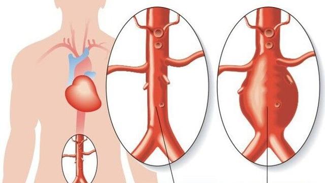 '조용한 시한폭탄' 복부 대동맥류…13년간 3배 급증, 왜?